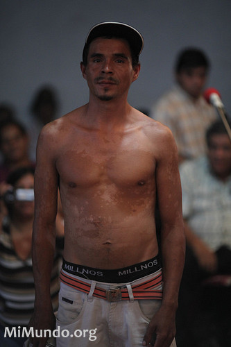 A man affected by Goldcorp's San Martin mine in Honduras shows his skin problems at the Tribunal