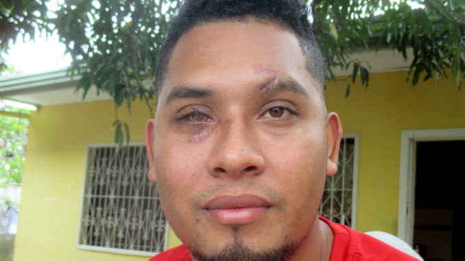 José Luis Ortiz was shot in the face with a tear gas canister when police cracked down on a protest against election fraud in El Progreso, causing severe damage to his right eye. Photo by Sandra Cuffe